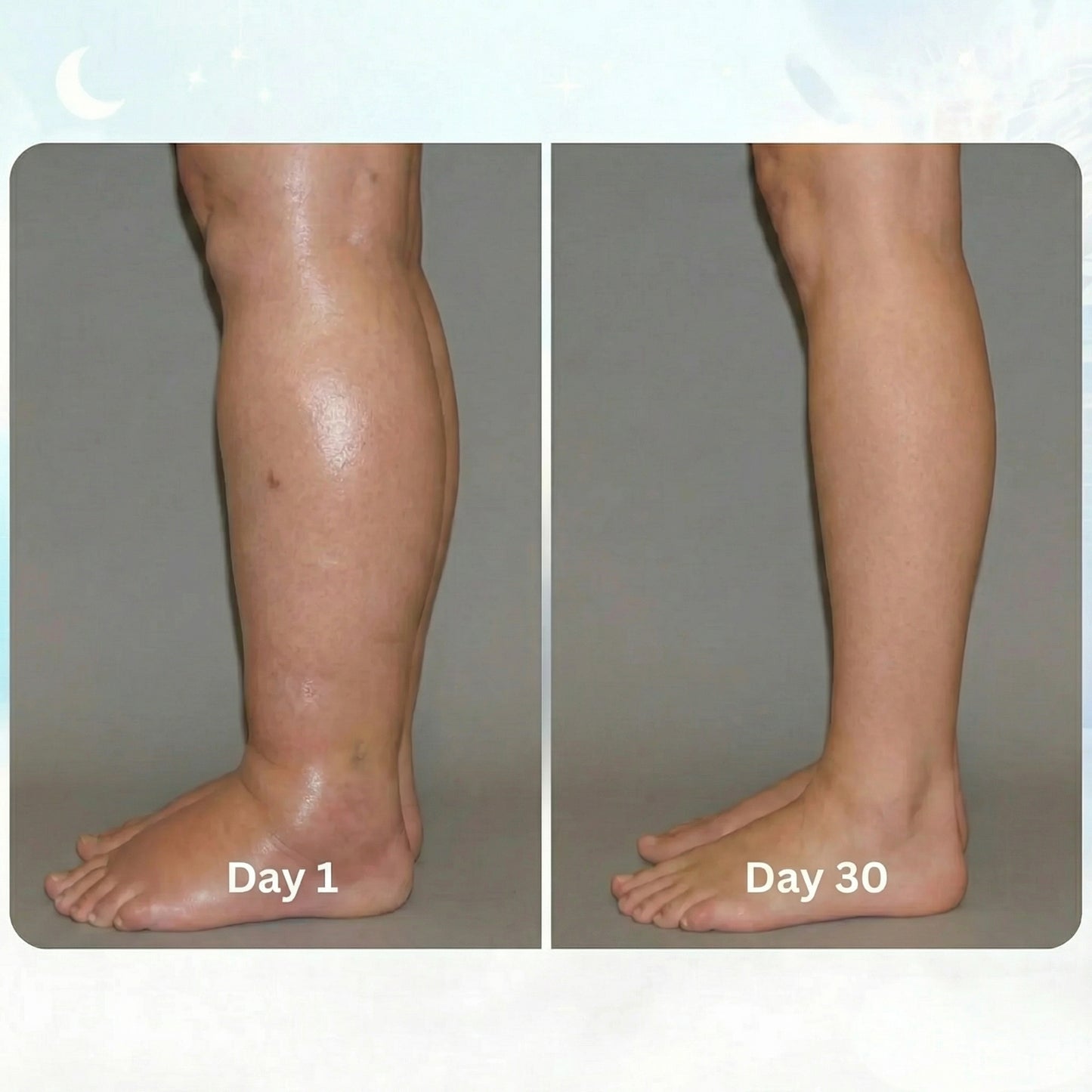 VASCORA - EMS FIX SWOLLEN LEGS FROM HOME